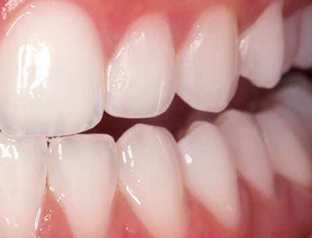 after-whitening